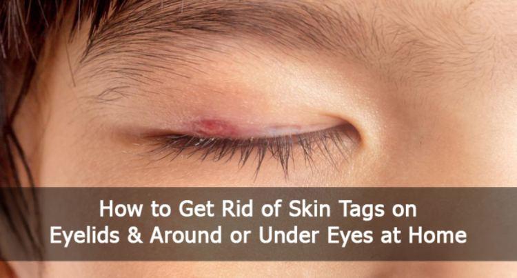 How To Remove Skin Tag on Eyelid