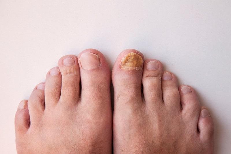 Best Cure for Nail Fungus