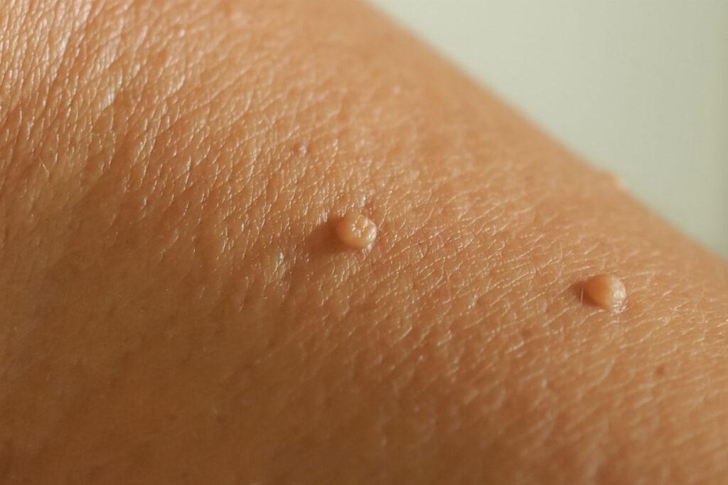 How Does Tag Away Skin Tag Remover Work?